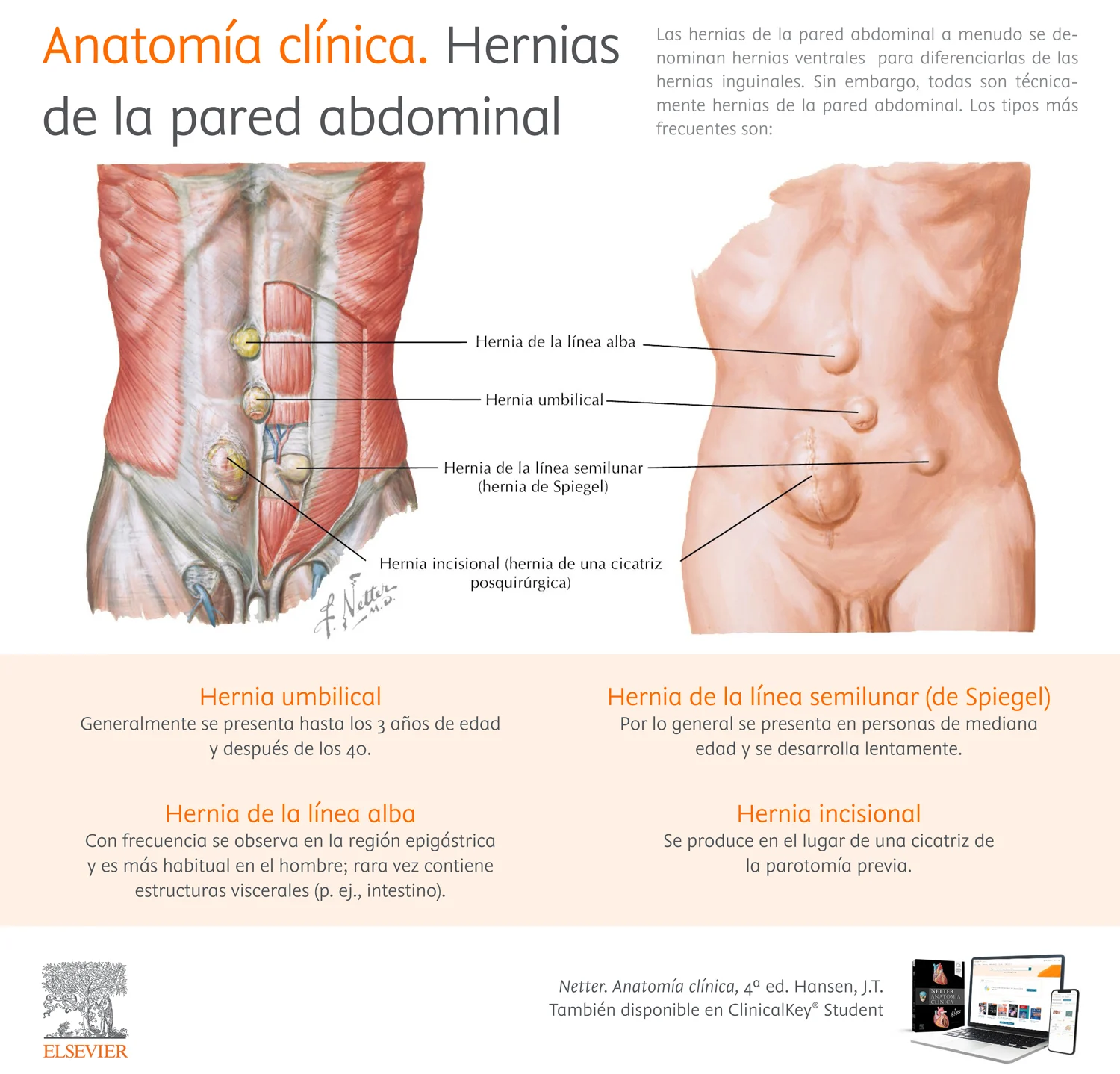 Infografia Anatomia - Clinica Hernias - pared-abdominal