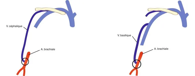 Figure 6.3. Fistule proximale brachio-céphalique. Figure 6.4. Fistule proximale brachio-basilique.