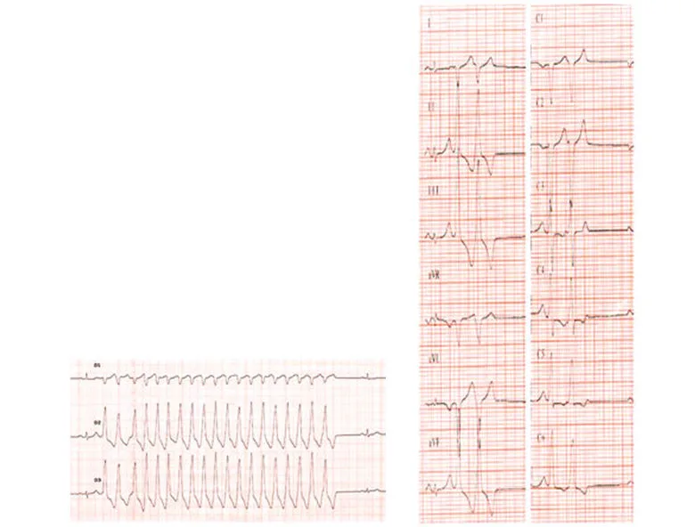 Troubles du rythme et de la conduction A