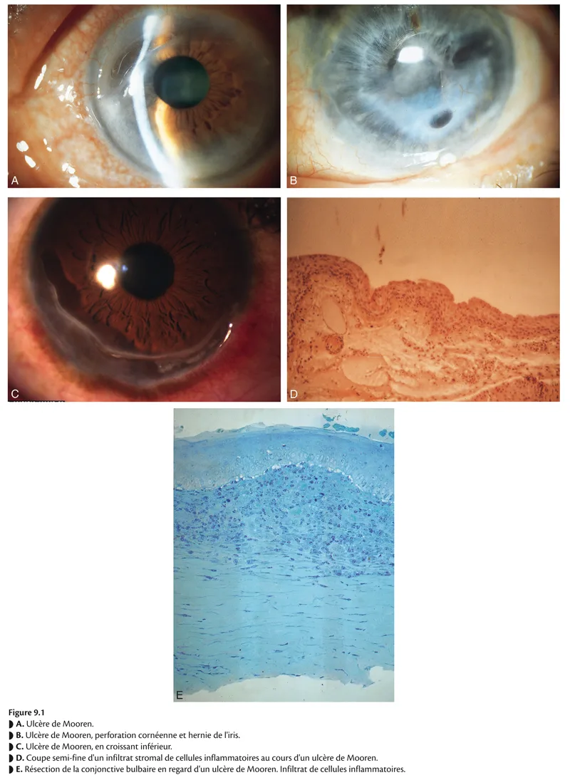Figure 9.1 - La cornée : Pathologie stromale