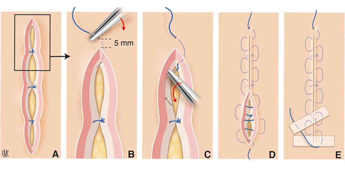 Techniques de sutures, dans le traité EMC de CK Now DERMATOLOGIE