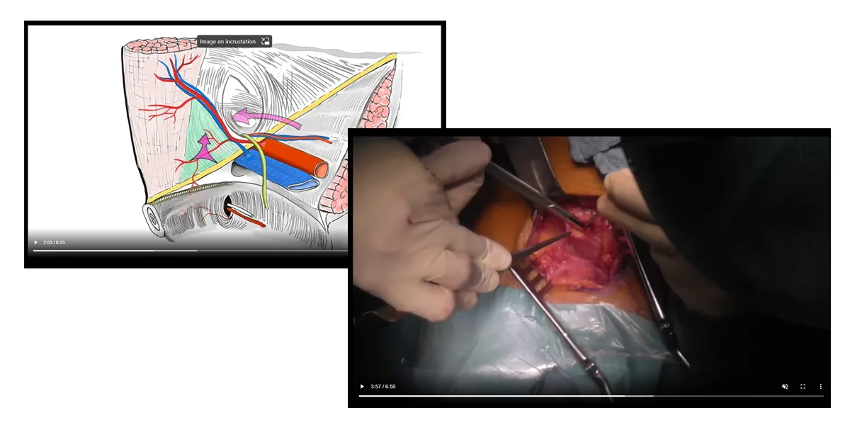 Vidéos en chirurgie viscérale thumbnails