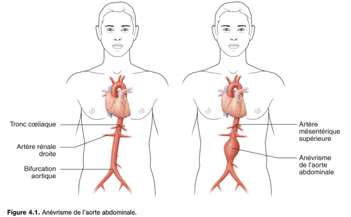 Anévrisme de l'aorte