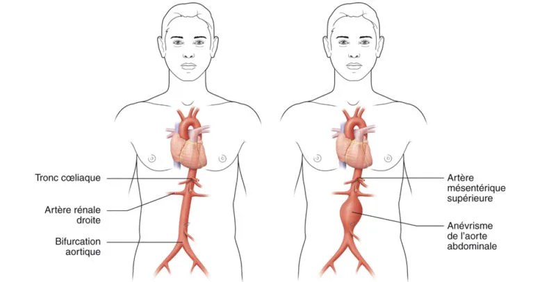 Anévrisme de l’aorte abdominale.