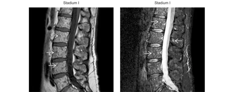 IRM T1 sagittale et  IRM STIR sagittale à travers la colonne lombaire