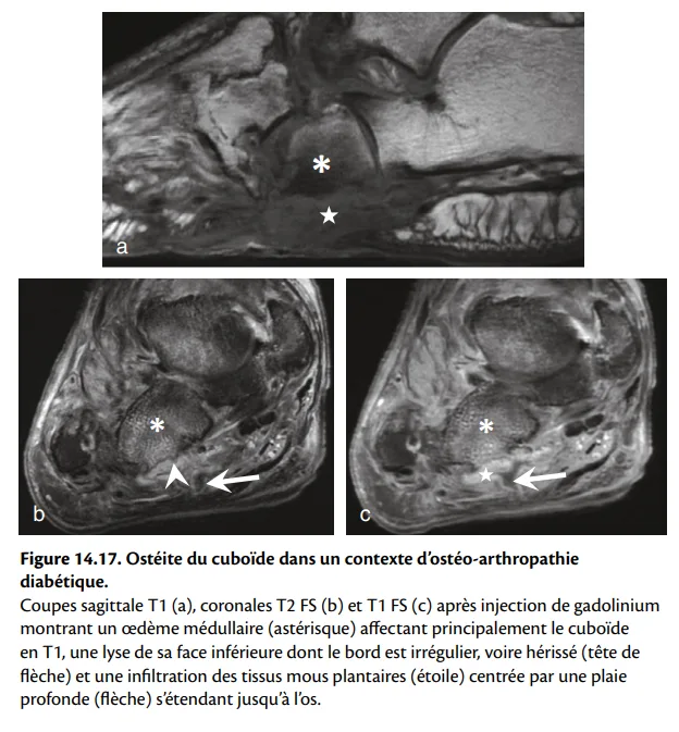 Figure 14.17: Ostéite du cuboïde dans un contexte d'ostéo-arthropathie diabétique 