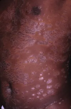 Psoriasis