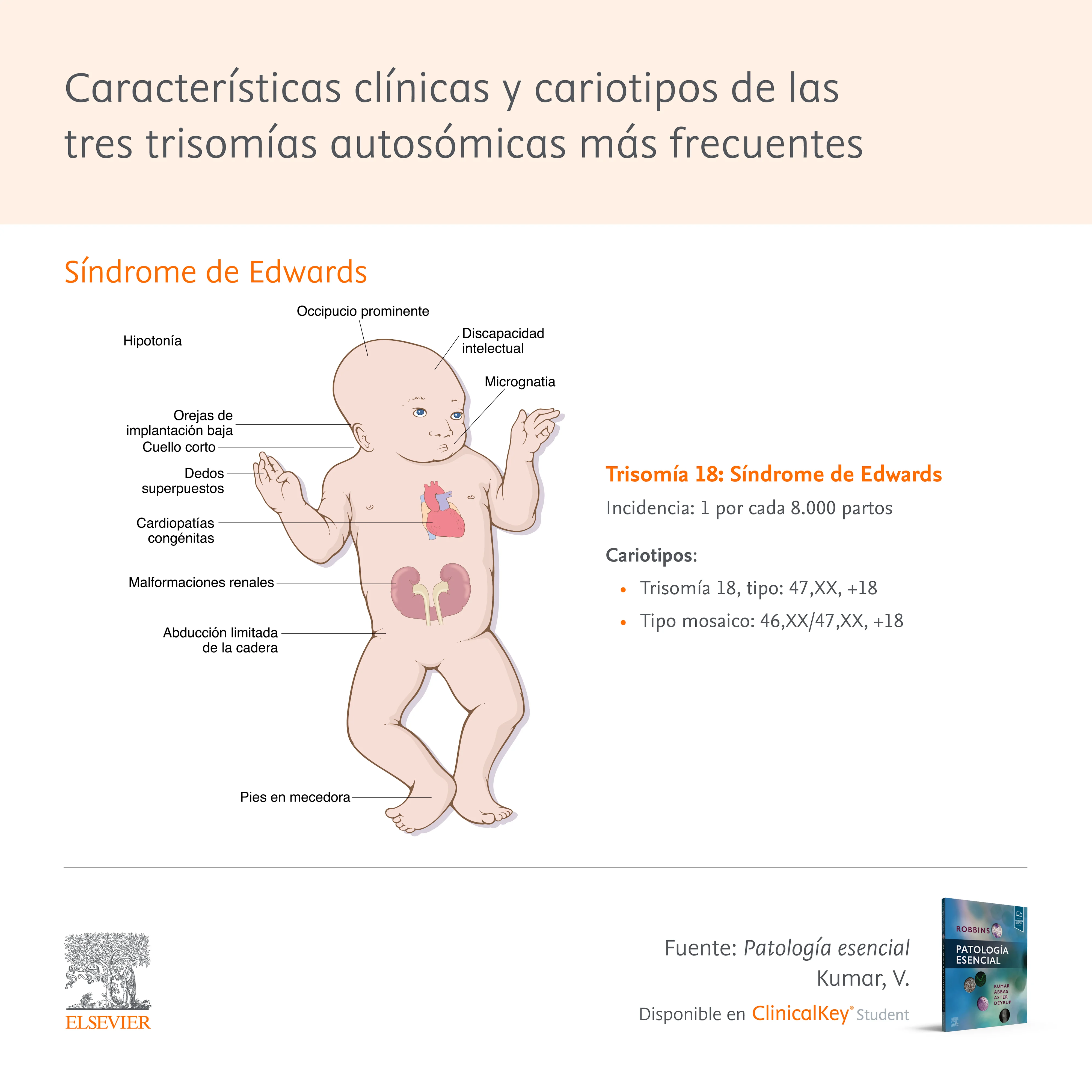 Infographic: Tres trisomías autosómicas más frecuentes