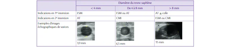 Tableau 8.1 Tableau récapitulatif des indications des traitements des saphenes selon leurs diamétres