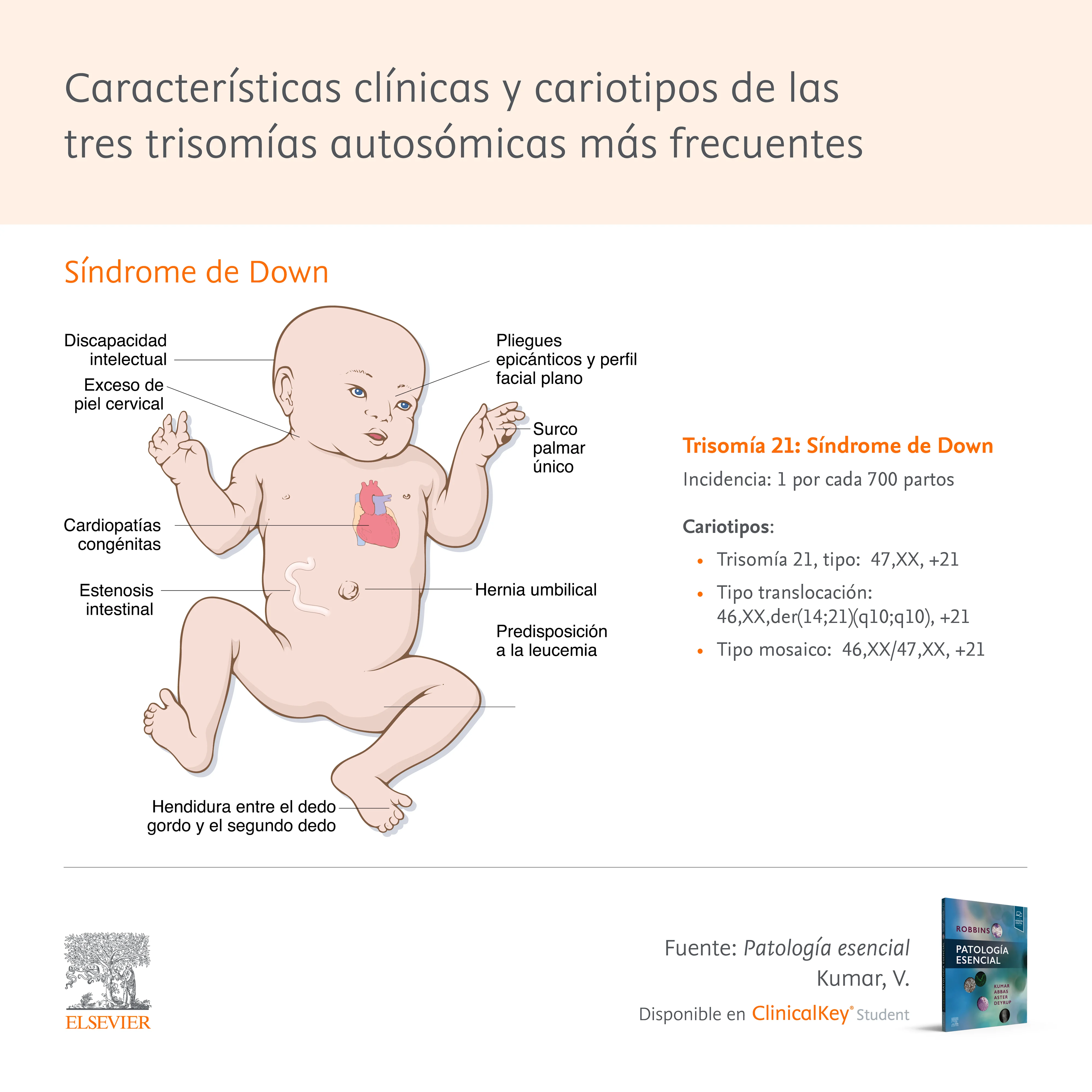 Infografia: Tres trisomías autosómicas más frecuentes