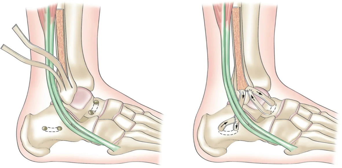 Figure 20.9 (Cliquez pour agrandir) Réparation anatomique avec renfort au périoste-ligamentoplastie anatomique au périoste (technique de Roy-Camille)
