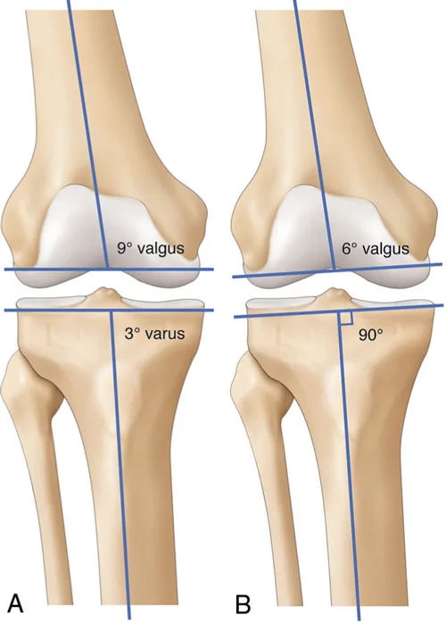 Alignement dans les prothèses totales de genou