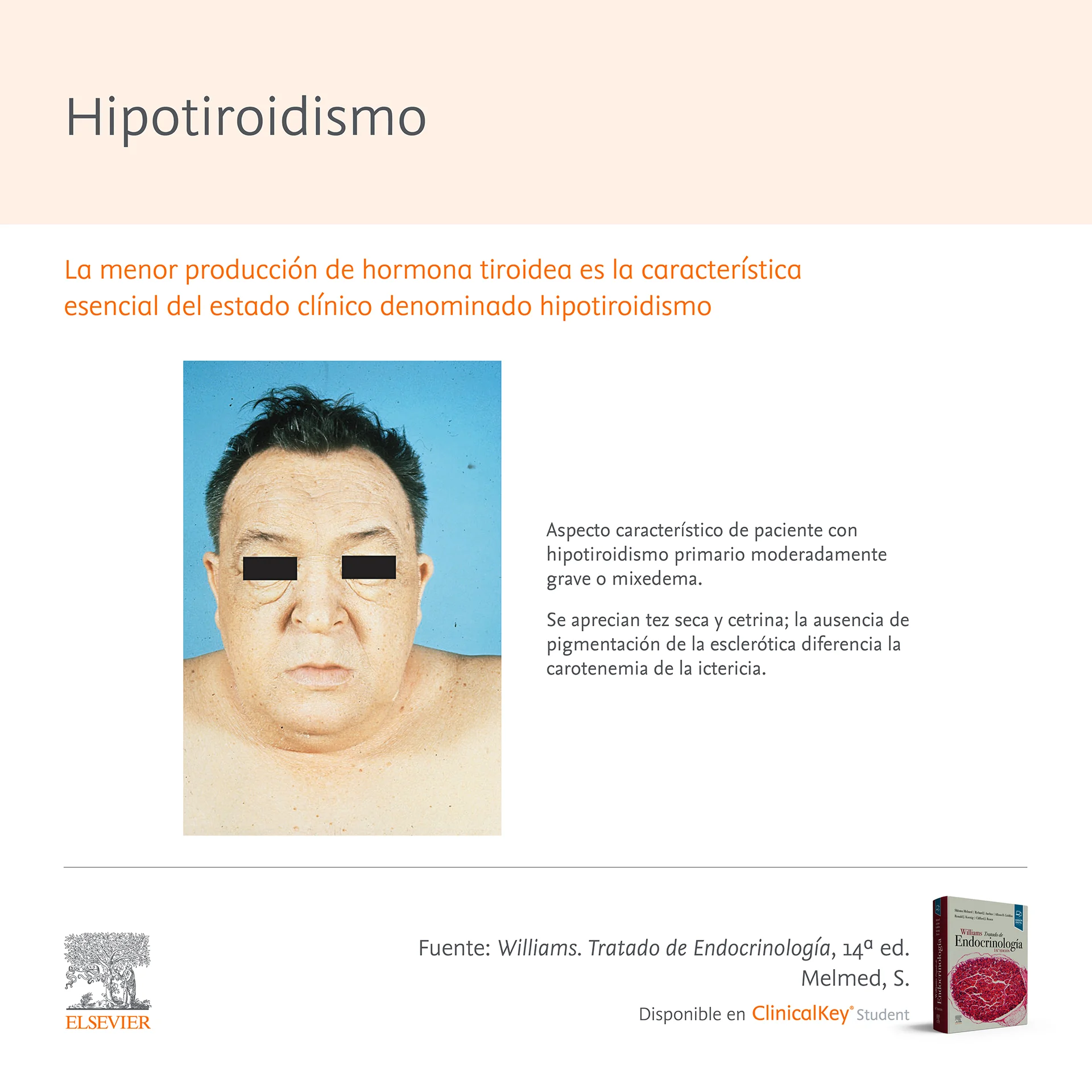 Infografia SLM Williams Hipotiroidismo 2