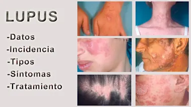 Lupus mayo