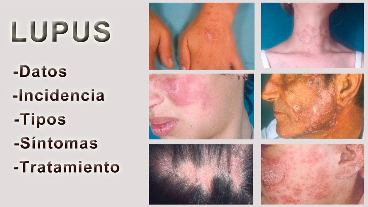 Tipos de lupus: causas, síntomas y tratamiento