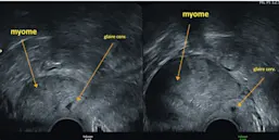 Pathologie du col utérin