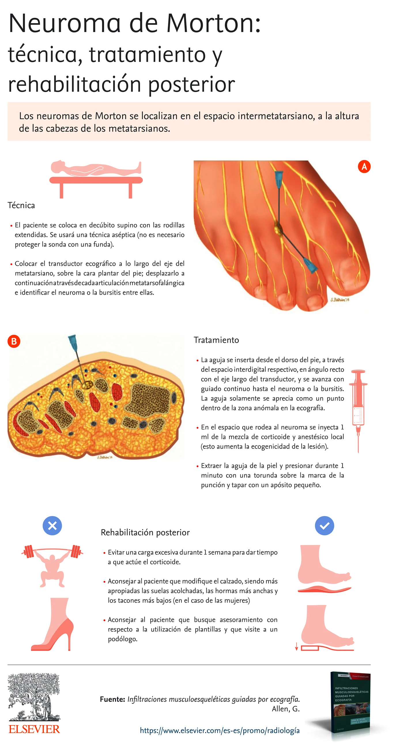 Neuroma Morton infografia