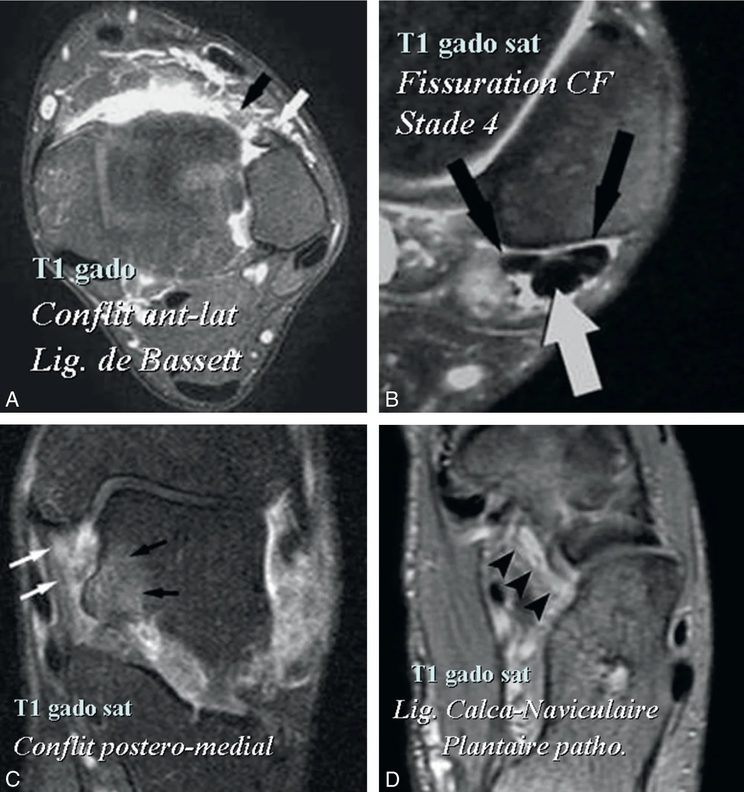 Figure 20.5 (Cliquez pour agrandir) IRM-gadolinium de la cheville