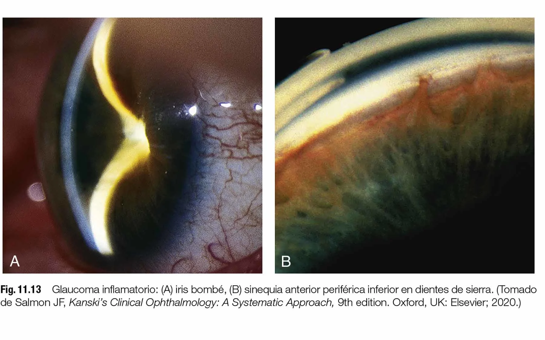 Glaucoma-inflamatorio