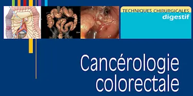 Cancer colorectal