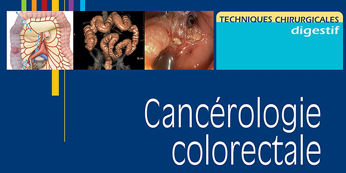 Cancer colorectal