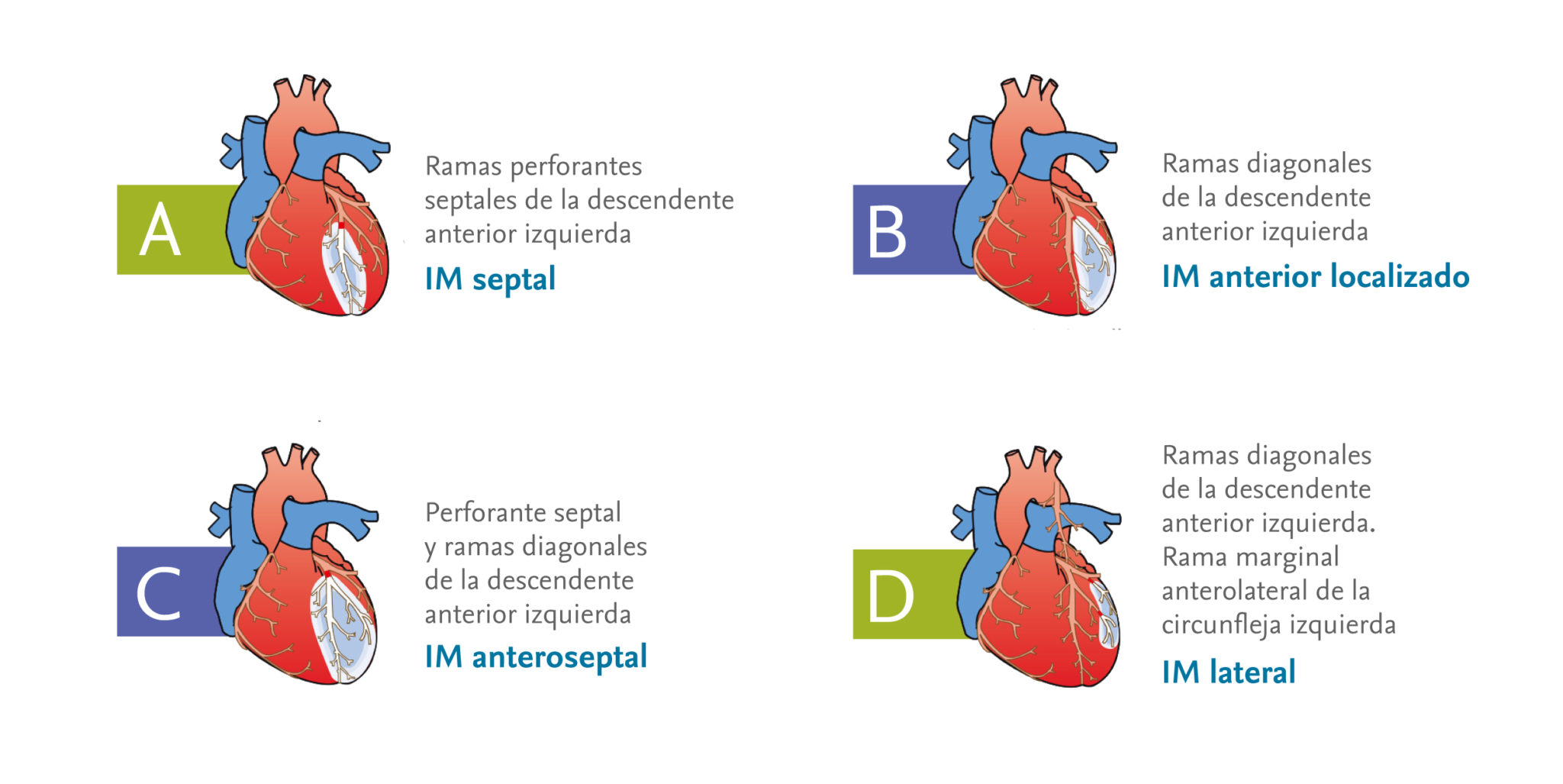 electrocardiograma de infarto de miocardio lateral