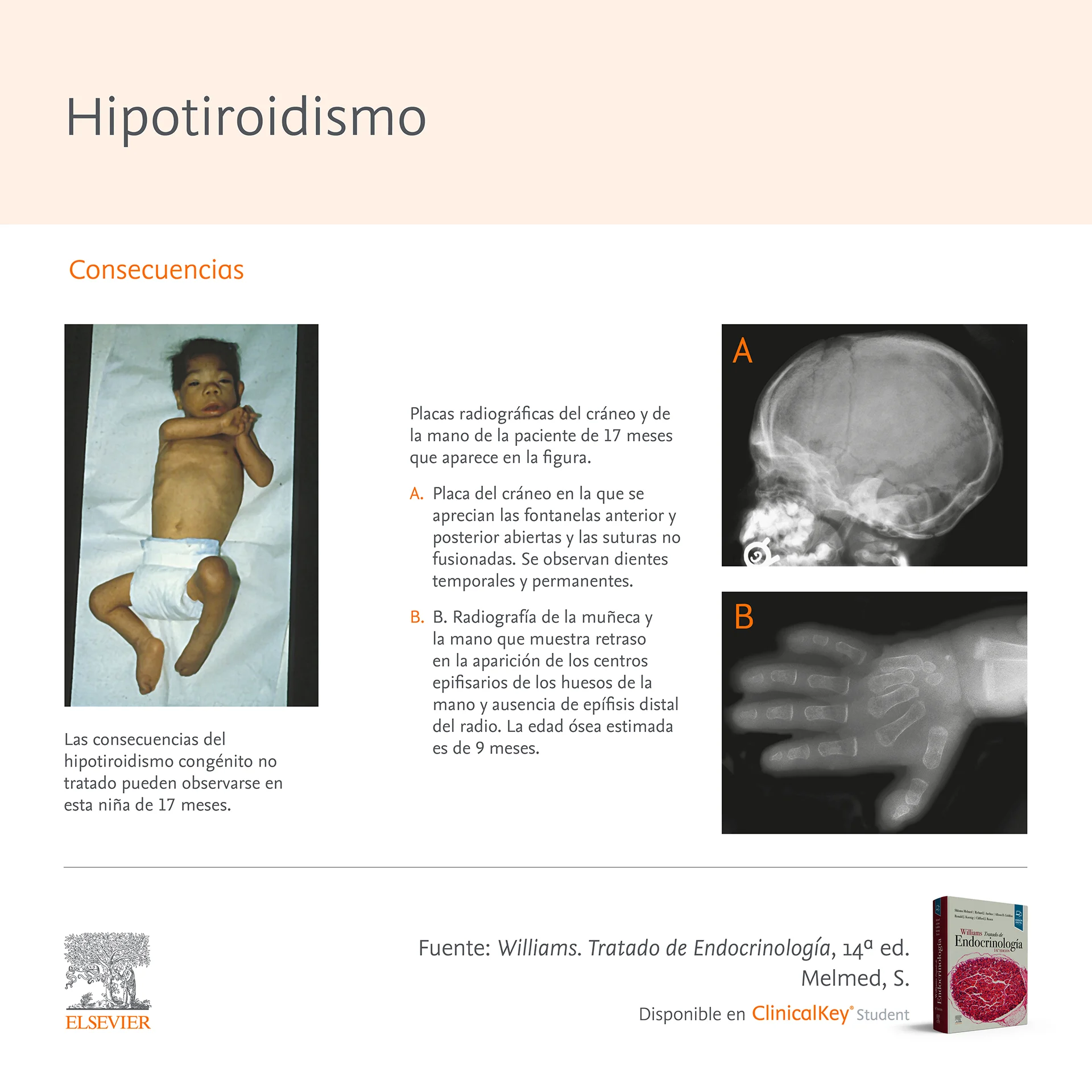 Infografia SLM Williams Hipotiroidismo 3
