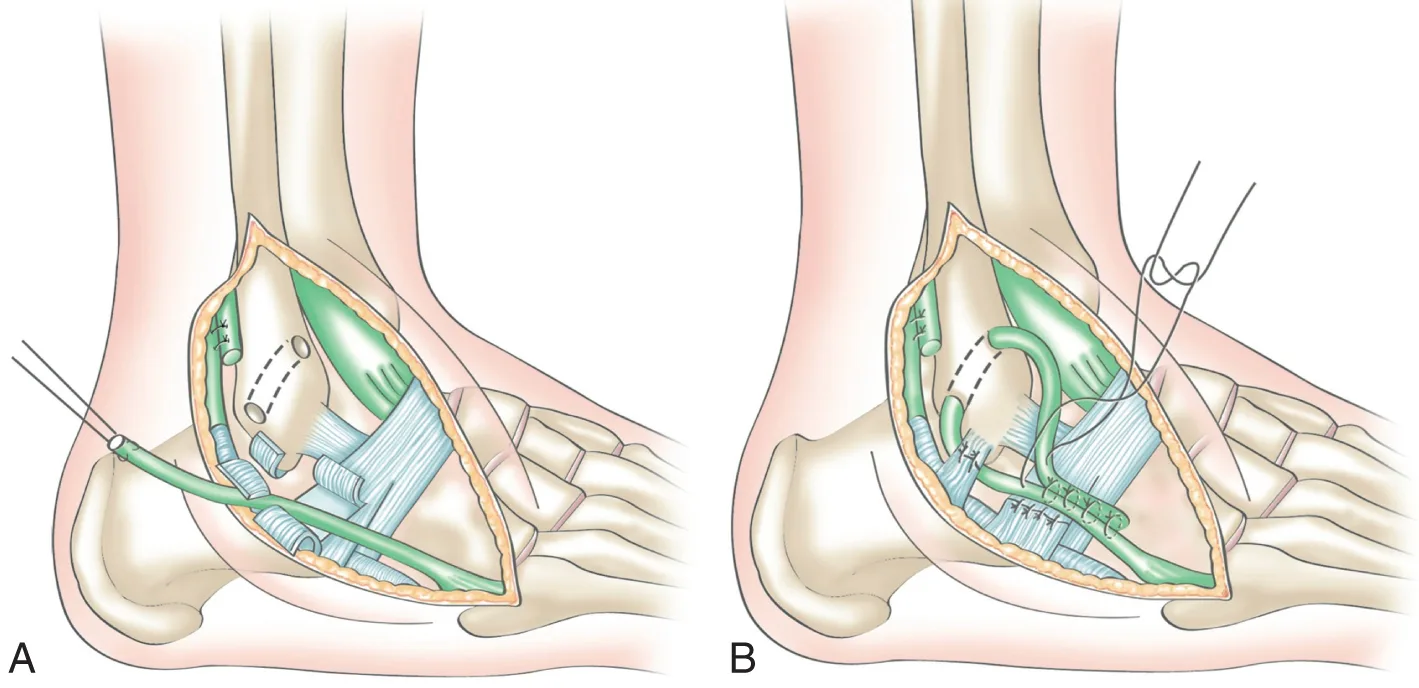 Figure 20.13 (Cliquez pour agrandir) Reconstruction non anatomique au court fibulaire (technique de Castaing)