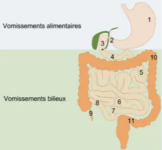 Représentation schématique du type de vomissements en fonction de la localisation de l’obstacle par rapport à l’ampoule hépato-pancréatique (ampoule de Vater, astérisque) et principales étiologies des occlusions digestives en pédiatrie