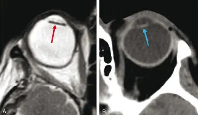 Figure 6.5. Implant après intervention pour cataracte sur globe myope en IRM T2 (flèche rouge) (A) et en scanner (flèche bleue) (B)