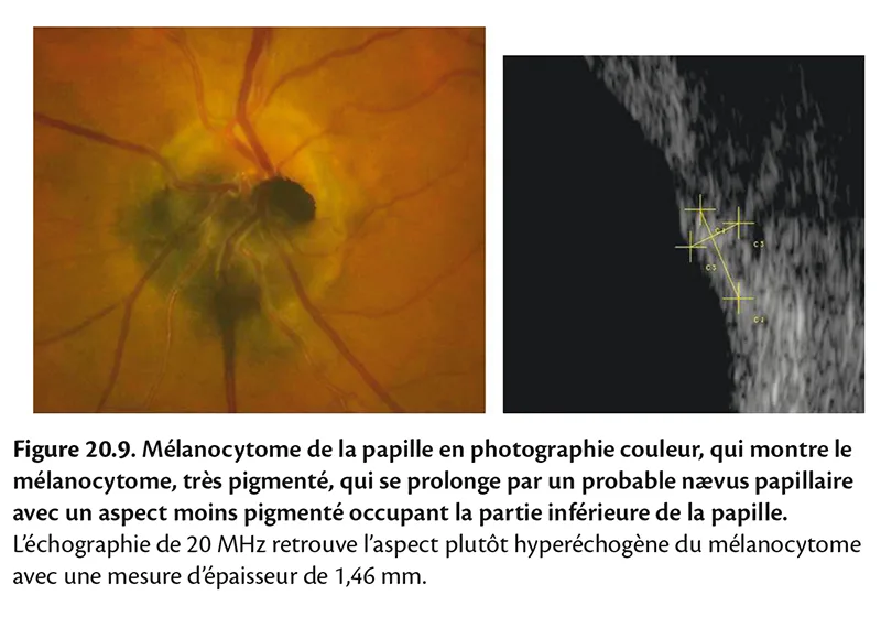 Exploration de la papille par échographie