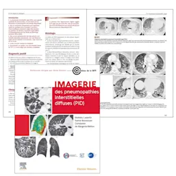 Maladies pneumonaires