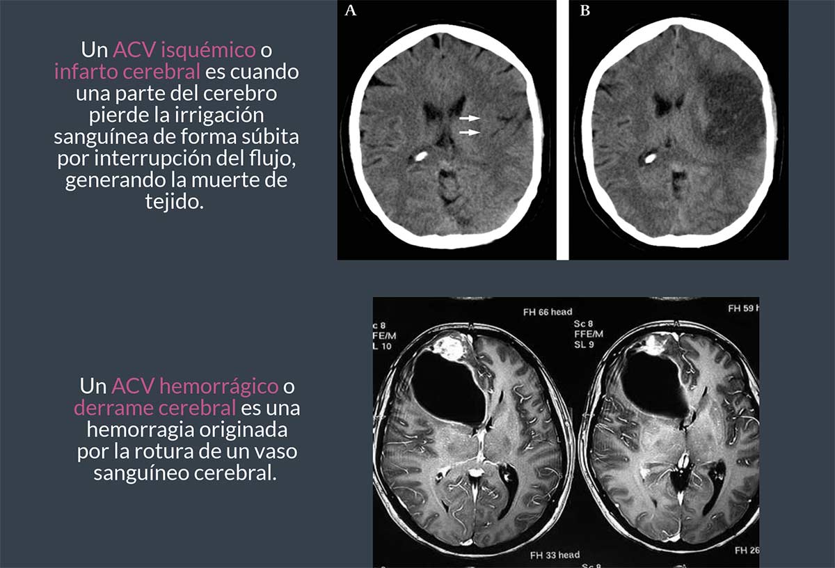 accidente cerebrovascular isquémico vs hemorrágico resonancia magnética