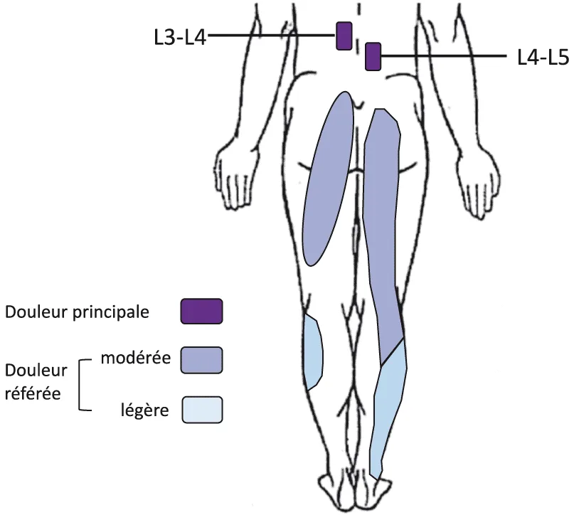 Irradiations de la douleur d’origine facettaire.