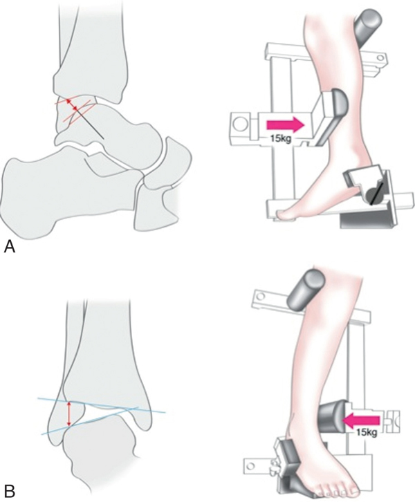 Les techniques de reconstruction du plan capsulo