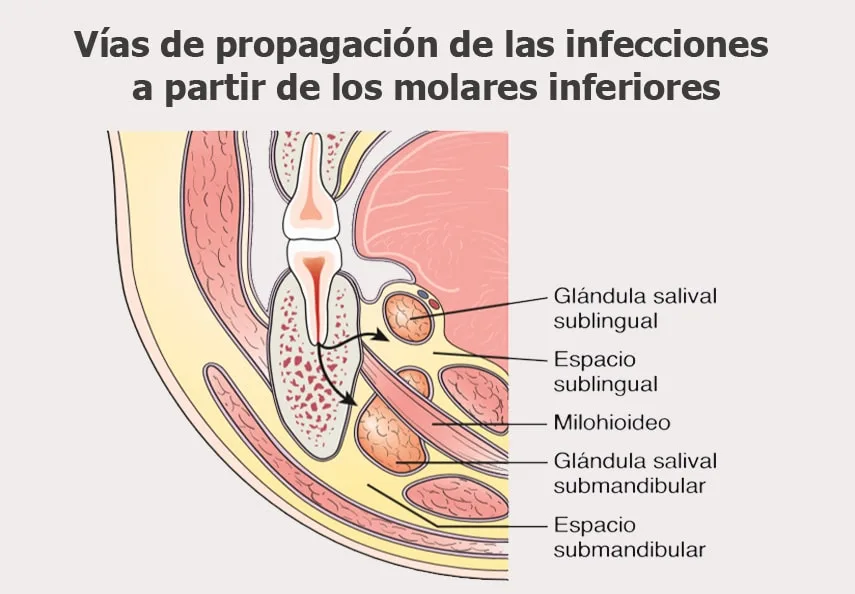 Vias de propagacion de las infecciones a partir de los molares inferiores