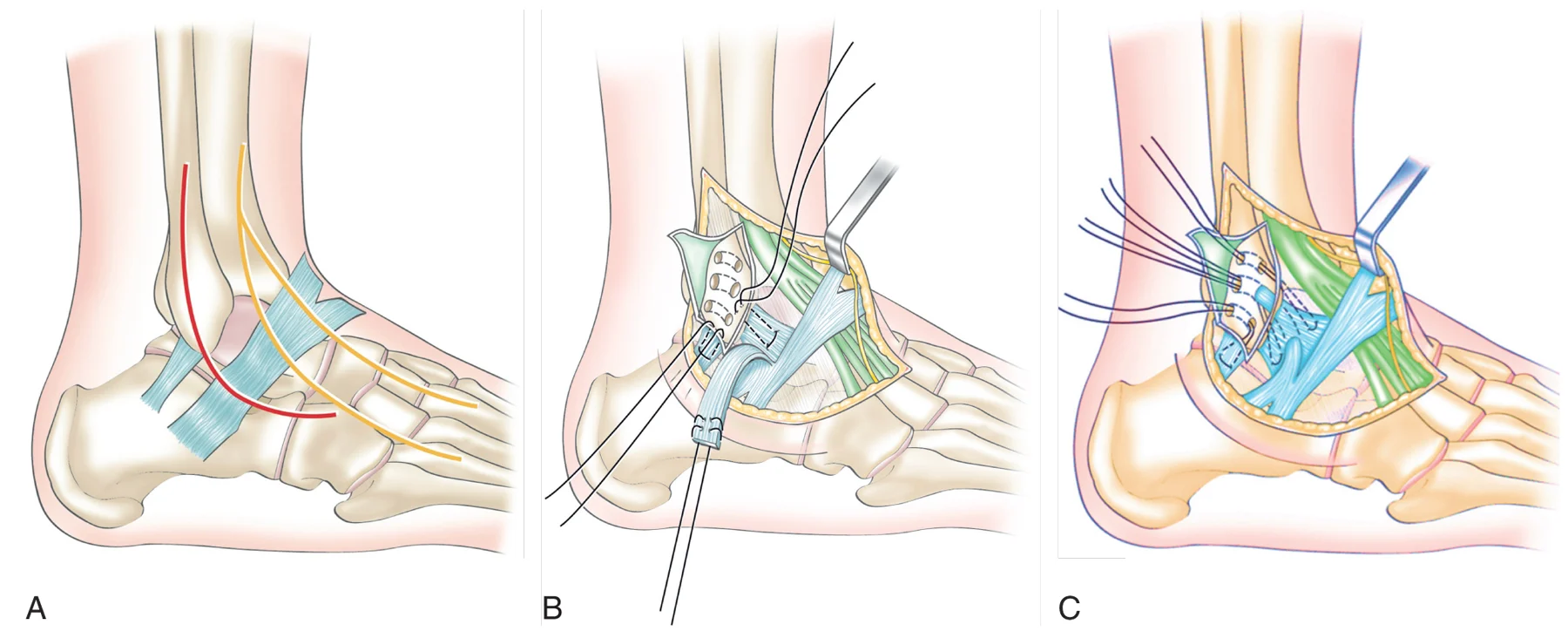 Figure 20.8 (Cliquez pour agrandir) Réparation anatomique avec renfort au ligament frondiforme