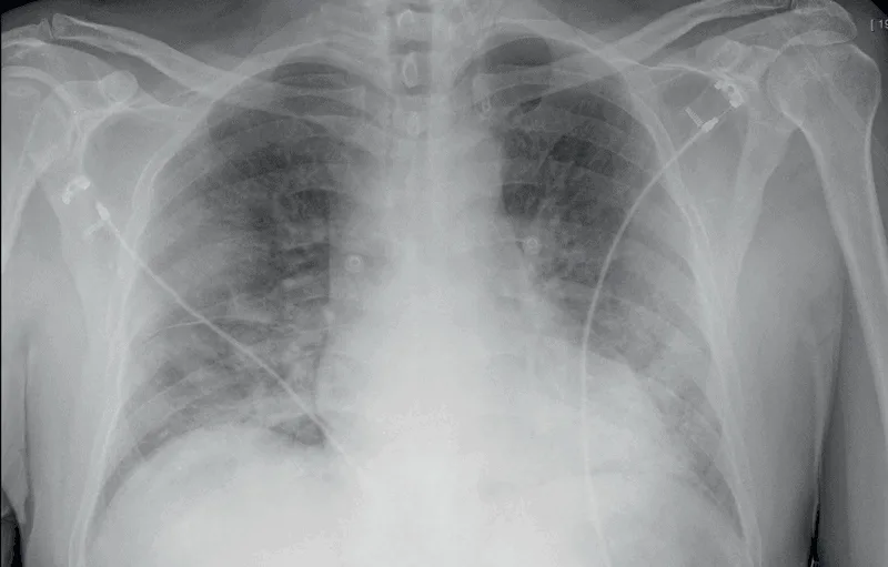 Figure 3 Radiographie COVID