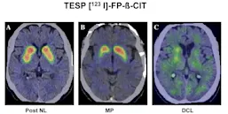 Utilisation de l’imagerie cérébrale dans notre pratique face à un syndrome parkinsonien