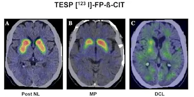 Utilisation de l’imagerie cérébrale dans notre pratique face à un syndrome parkinsonien