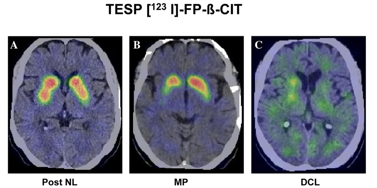 Utilisation de l’imagerie cérébrale dans notre pratique face à un syndrome parkinsonien