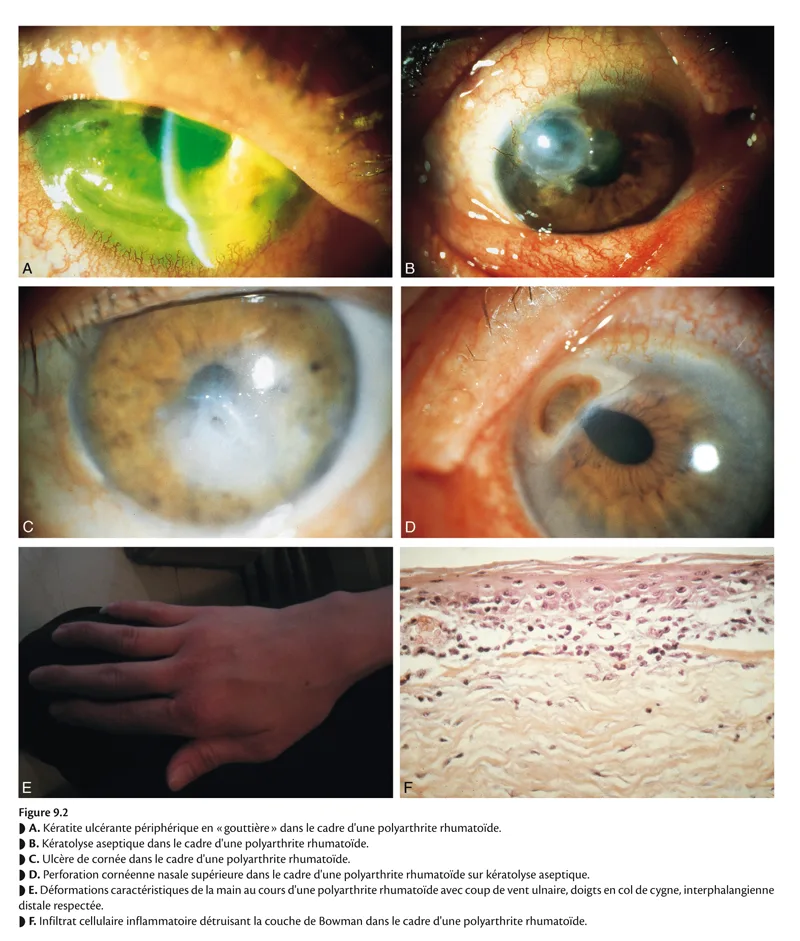 Figure 9.2 - La cornée : Pathologie stromale