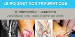 Prothèse trapézo-métacarpienne