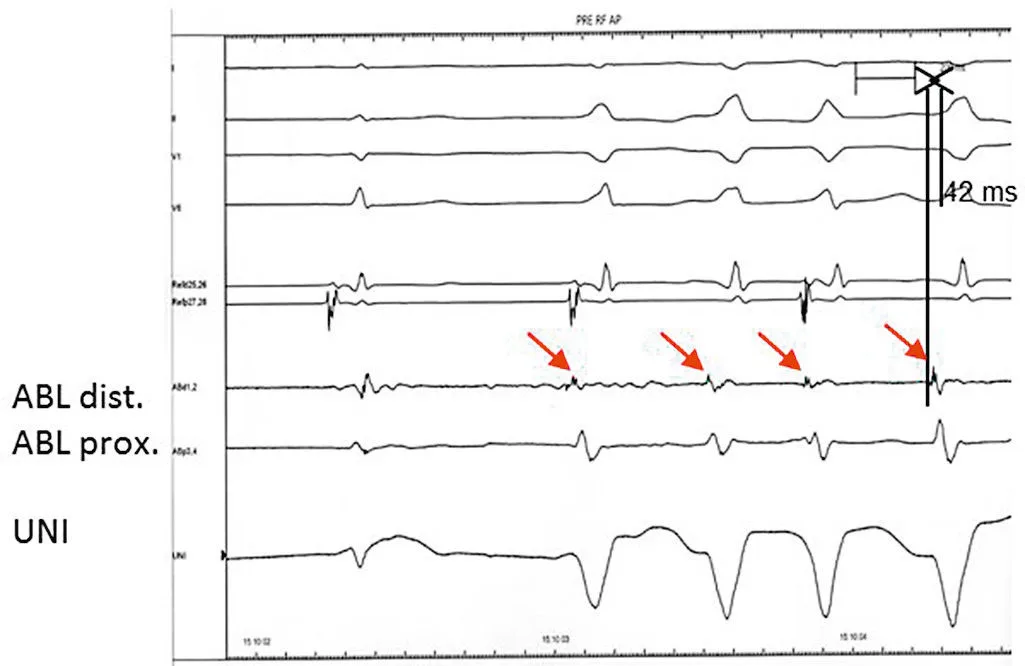 Troubles du rythme et de la conduction C