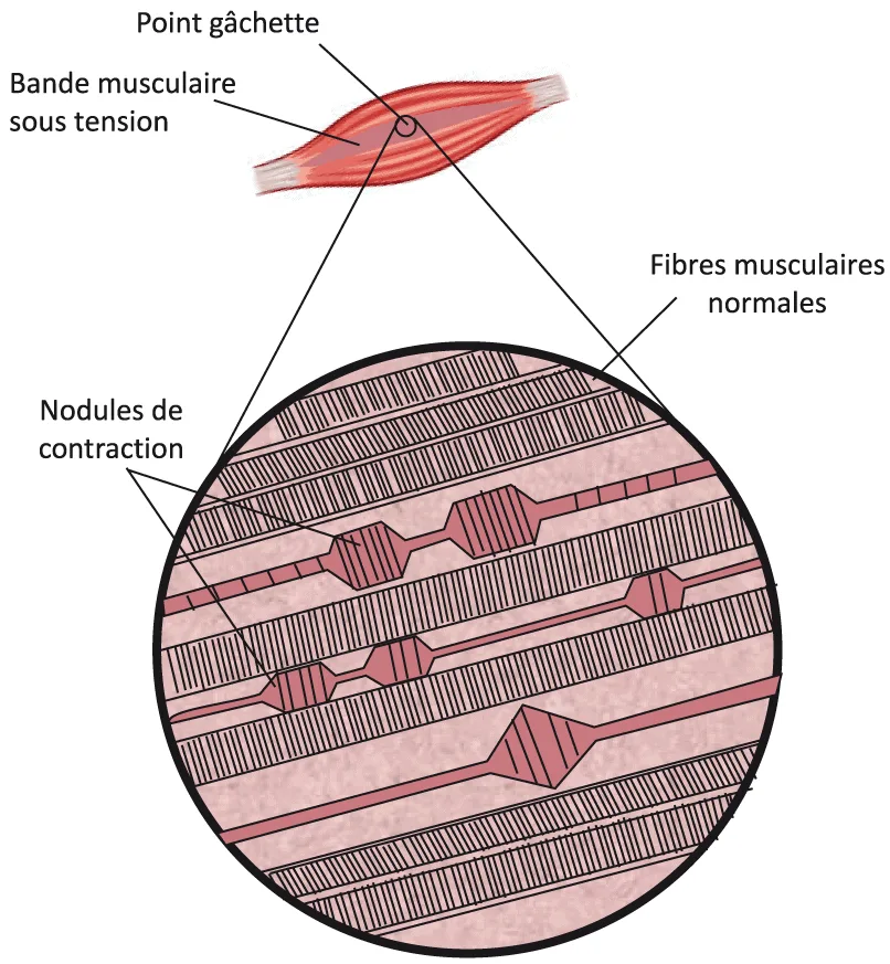 Point gâchette myofascial.