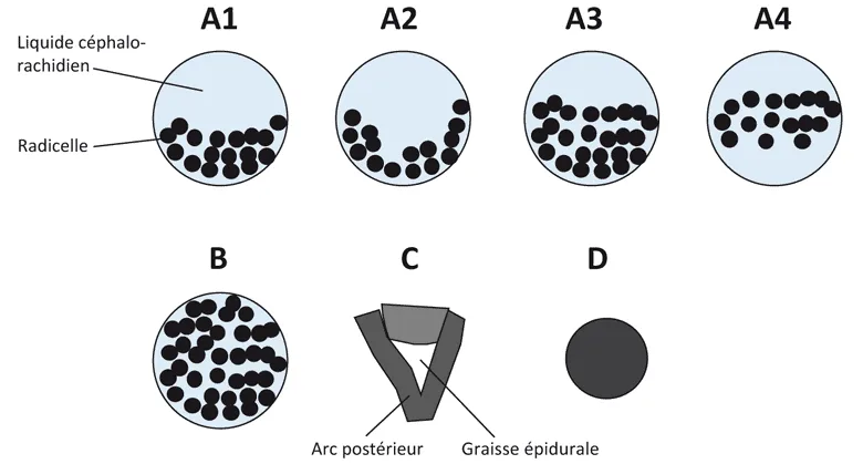 Classification de Lausanne (selon Schizas et coll.).