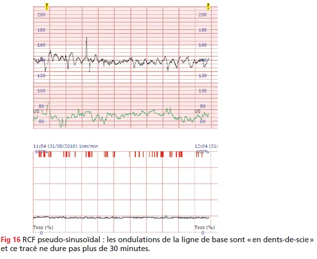 Inphographie Rcc Idées reçues sur le RCF