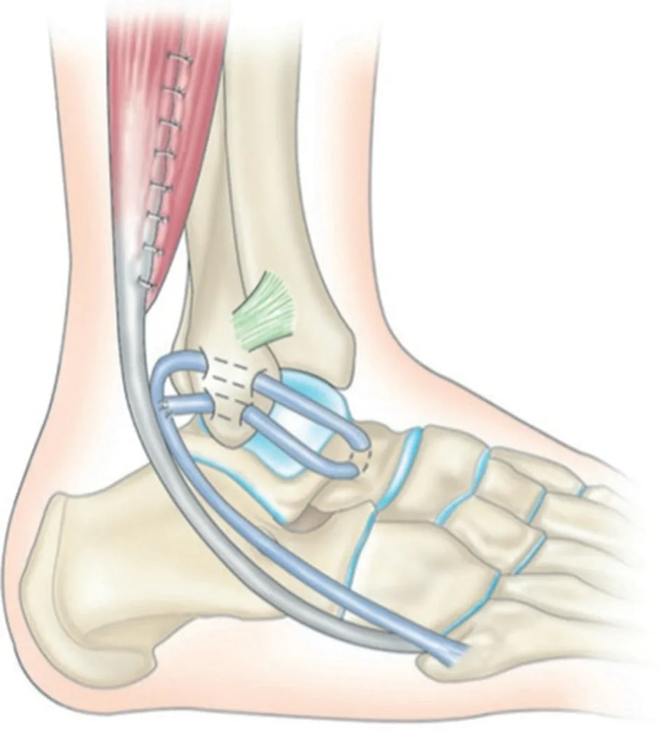 Figure 20.12 (Cliquez pour agrandir) Reconstruction anatomique au court fibulaire (technique de Watson-Jones)