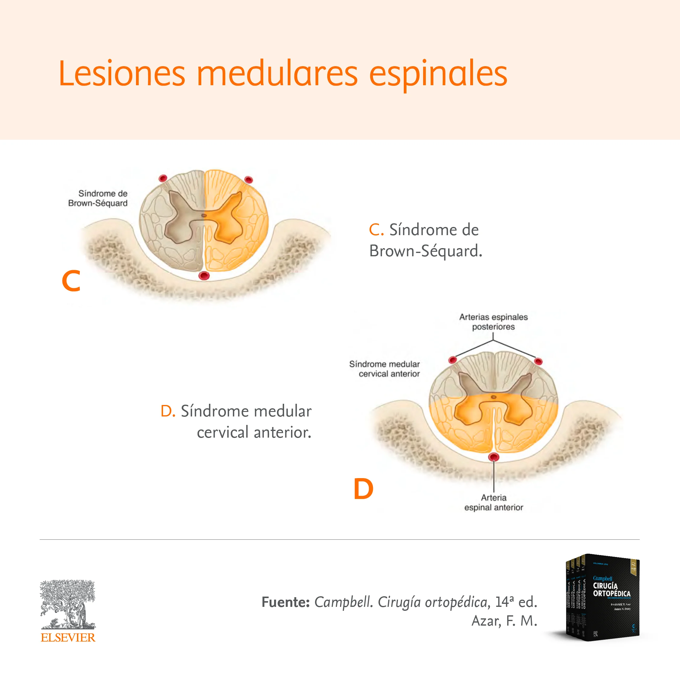 Síndromes medulares y sus características