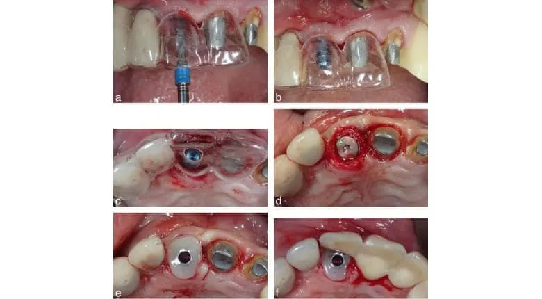 Chirurgie implantaire avec un guide chirurgical